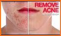 Acne Remover Photo Editor (Alpha) related image