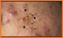 Pimple Pop Squeeze related image