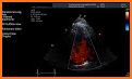 LEARN THE FULL TTE ECHO ULTRASOUND PROTOCOL DEMO related image