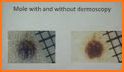 AI Dermatology - Skin Disease Diagnosis related image