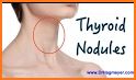 Thyroid Nodules related image