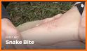 Snake Bite related image