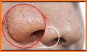 How to Remove Blackheads related image