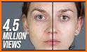 Acne Remover Photo Editor (Alpha) related image