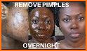 Acne Treatment Remedies For Pimples, Skin & Face related image