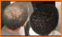 Natural Baldness Treatments related image