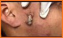Ice Queen Pimple Popping: Beauty Skin related image