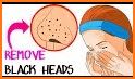 Get Rid Of Blackheads Naturally - 12 Home Remedies related image