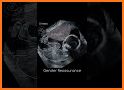 Momitalk: Pregnancy Ultrasound related image