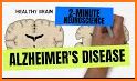 Alzheimer's Disease (MIND) related image