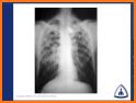 Chest X-Ray And Pathology related image