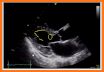 HEART EJECTION FRACTION: HOW TO EYEBALL THE EF related image