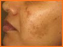 Blemish Remover related image