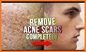 Acne Scar Removal related image