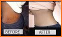 Stretch Marks removing related image