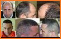 Hair Transplantation Istanbul / How Much Grafts? related image