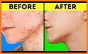Prevent Acne Tips related image