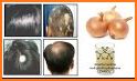 Treatment of hair loss related image