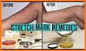 Get rid of STRETCH MARKS - Home Remedies related image