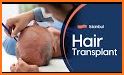 Hair Transplantation Istanbul / How Much Grafts? related image