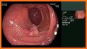 Endoscopic Classifications related image
