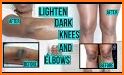 Get Rid Of Dark Knees And Elbows Fast & Naturally related image