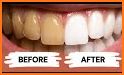 Whiten teeth naturally related image