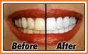 Tips Dientes Blancos related image