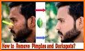Pimple Remover Photo Editor related image