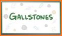 Gallstone Disease: Causes, Diagnosis,and Treatment related image