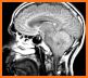 Understanding MRI: Multiple Sclerosis related image