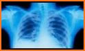 Lung Cancer Stage related image