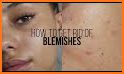 Face Blemishes Removal related image