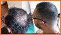 Baldness Thinning Hair related image