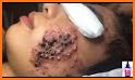 Ice Queen Pimple Popping: Beauty Skin related image