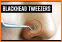 How to Remove Blackheads related image