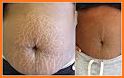 Stretch Marks removing related image