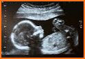 Baby Gender Predictor: Pregnancy Calc & Prediction related image