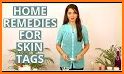 Skin tags Treatment and Home Remedies To Remove related image