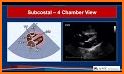 LEARN THE FULL TTE ECHO ULTRASOUND PROTOCOL DEMO related image