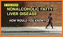 Fatty Liver (NAFL) related image