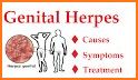 How to Prevent Herpes related image