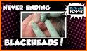 Blackheads Removal Videos related image
