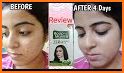 Roop - How to get rid of acne? related image