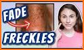 freckles tips related image