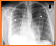 CXR FlashCards related image