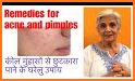 Acne & Pimples (Home Remedies) related image