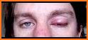 How To Treat A Stye related image