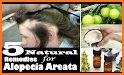 How to get rid of Alopecia related image