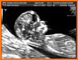 Ultrasound related image